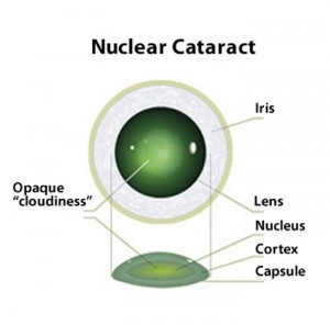 Cataract_1